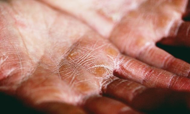 Eczema Relief Methods, Simple and Can Be Applied at Home