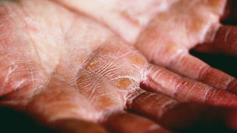 Eczema Relief Methods, Simple and Can Be Applied at Home 