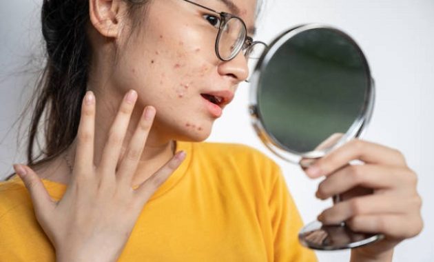 Natural Acne Treatment, Effective Solutions to Clear Your Skin