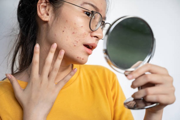Natural Acne Treatment, Effective Solutions to Clear Your Skin 